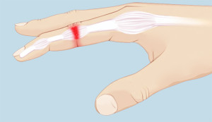 Diagram showing jammed index finger